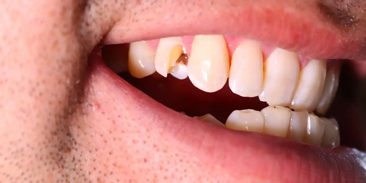 Cracked Tooth