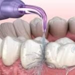 Professional Dental Cleanings