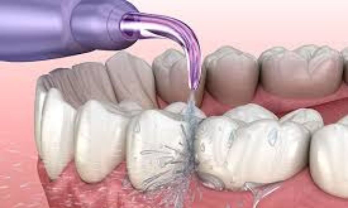 Professional Dental Cleanings